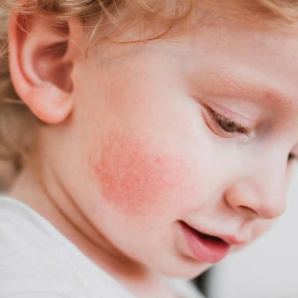 Pediatric Dermatology Zaaya Skin Hair And Laser Clinic