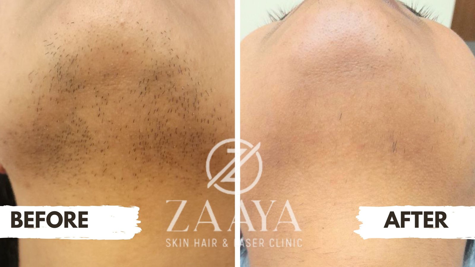 Laser hair reduction underarms