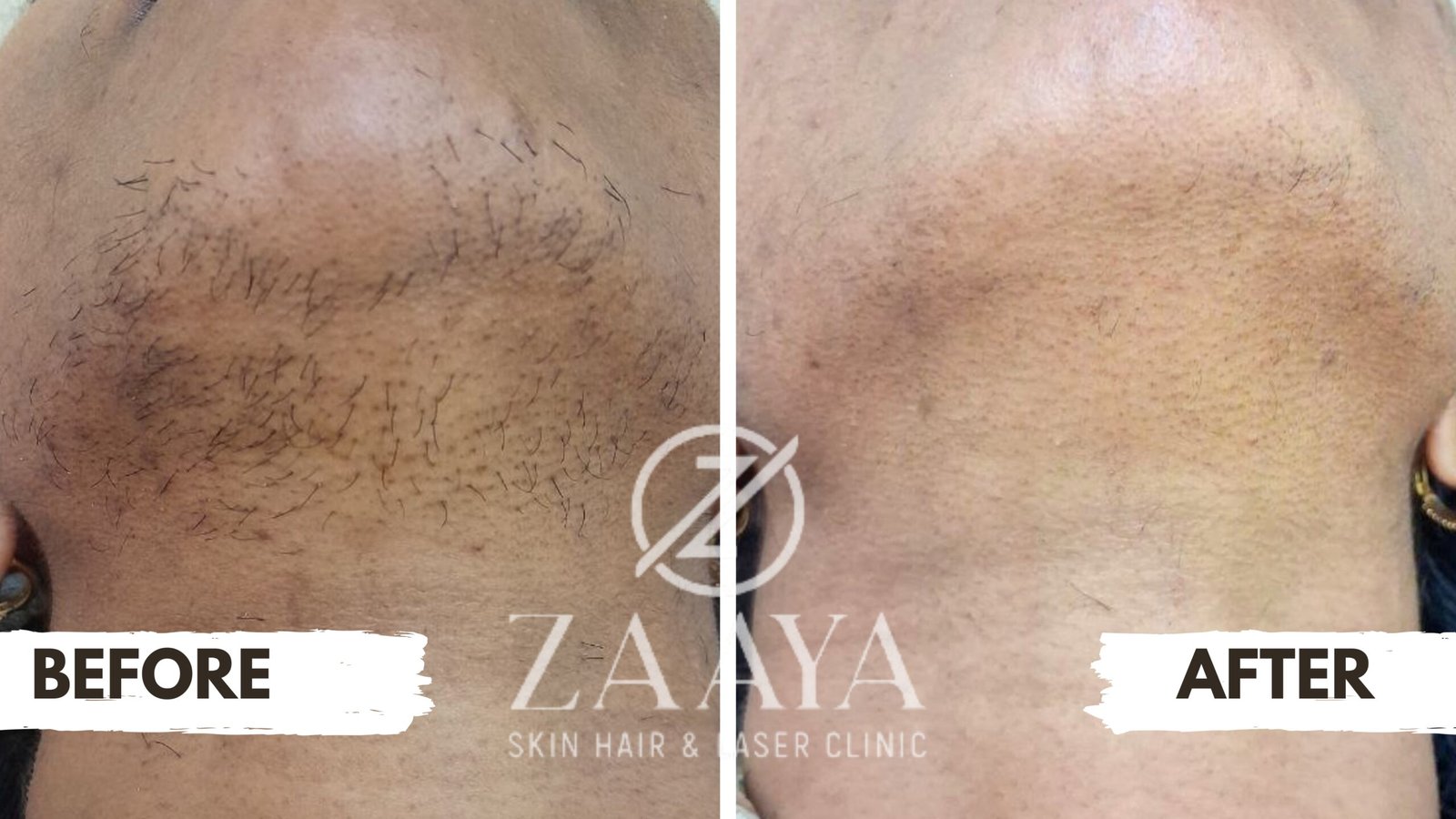 Laser hair reduction face