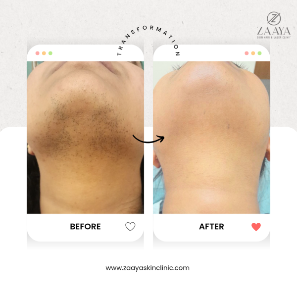 Advanced Laserhairreduction treatment